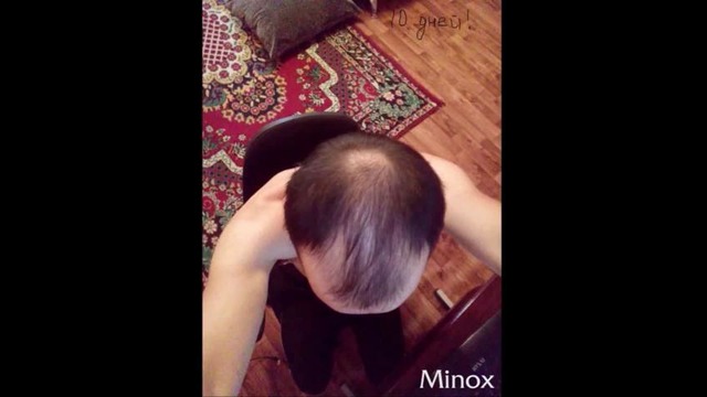 Лечение волос с Мinox