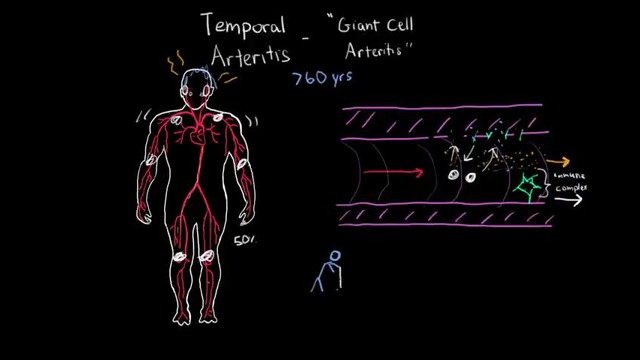 Large Vessel Vasculitis – Temporal Arteritis/Horton’s Disease