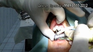 Стоматология DentalPremier – Имплантация зубов №1