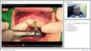 Вебинар: Концепция R2Gate one day implant