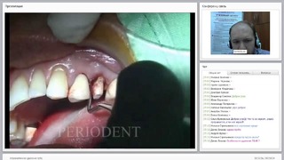 Вебинар: Атравматичное удаление зуба