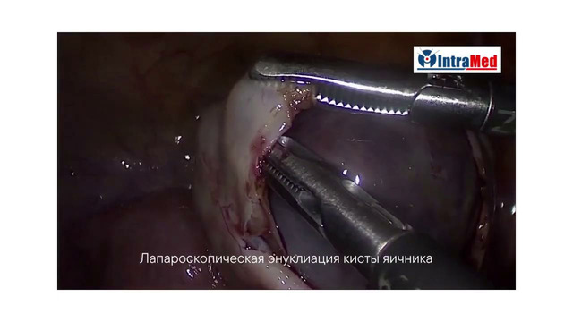Лапароскопическая энуклеация кисты яичника. Интрамед, г. Самарканд