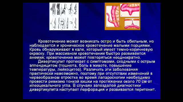 4 курс. Факультетская детская хирургия. Синдром острого живота (Алиев М.М.)