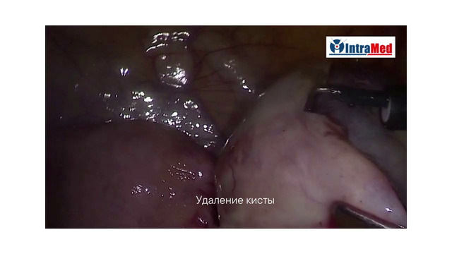 Операция по удалению субмукозной миомы и кисты. Интрамед, г. Самарканд