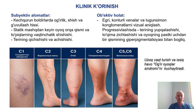 Unit 26. Mavzu 14. Oyoq venalarining varikoz kasalligi