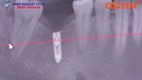 Продукция Osstem Implant