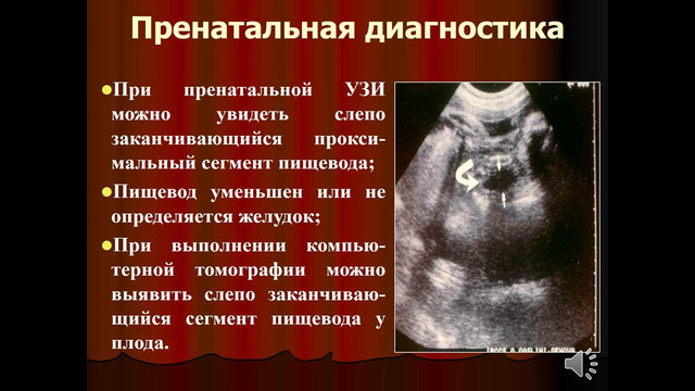 5 курс. Факультетская детская хирургия. Пороки развития пищевода