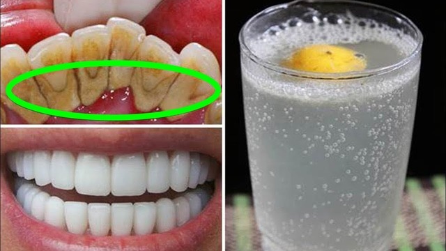 Как быстро отбелить зубы в домашних условиях