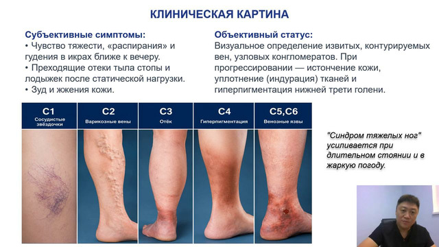 Unit 26. Тема 14. Заболевания вен нижних конечностей. Варикозная болезнь