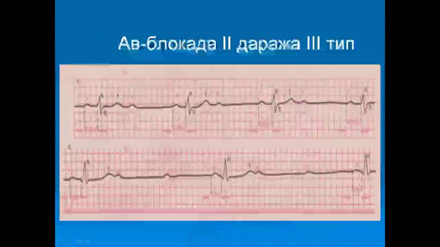 Брадиаритмии – Расулев Ё.Э