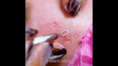 38 hacks to remove black spots and acne