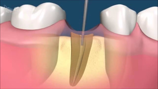Стоматология ЛОДЭ- Если кариес разрушает зуб