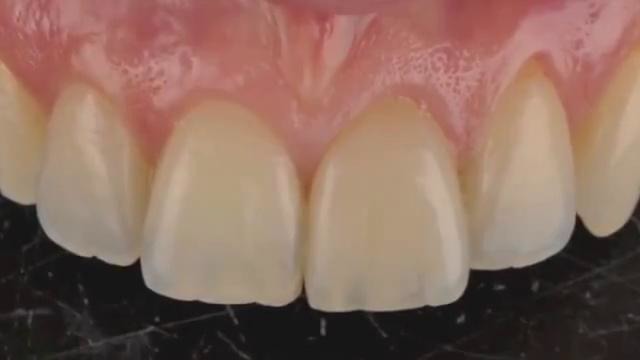 G.Ubassy-S.Koubi. Single veneer