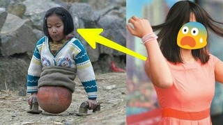 В детстве она потеряла обе ноги и передвигалась с помощью мяча