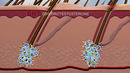 Диета при акне, которая уберет прыщи за неделю
