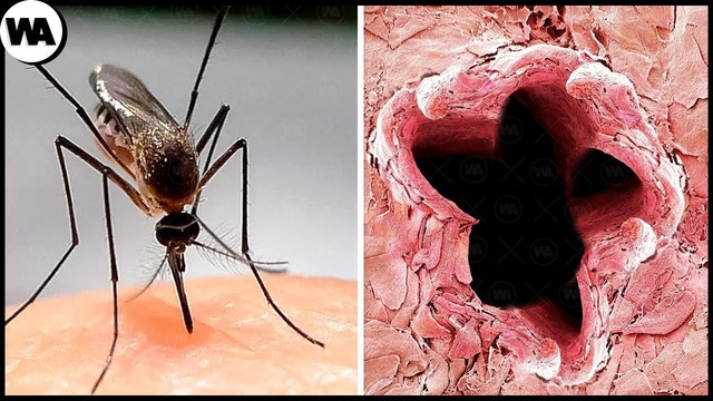 Вот Что Происходит, Когда Кусает Малярийный Комар