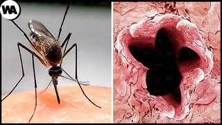 Вот Что Происходит, Когда Кусает Малярийный Комар
