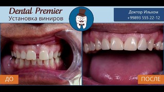 Стоматология DentalPremier – Виниры №1