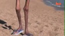 The Most Anorexic Woman In The World! Or Skinniest Woman in the world