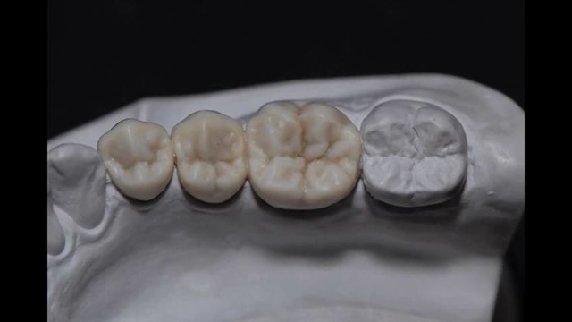 Full wax up