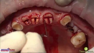 Вебинар: Реплантация зубов – резекция верхушки корня, техника root shield