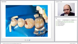 Вебинар: Создание контактных пунктов при реставрации боковых зубов