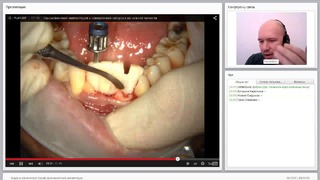 Вебинар: Видео и клинический случай одномоментной имплантации