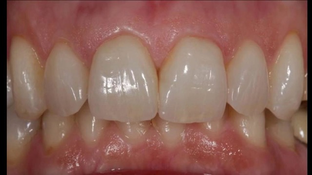Feldspathic Veneers by Nondas
