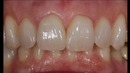 Feldspathic Veneers by Nondas