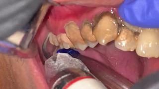 Чистка зубов от зубного камня