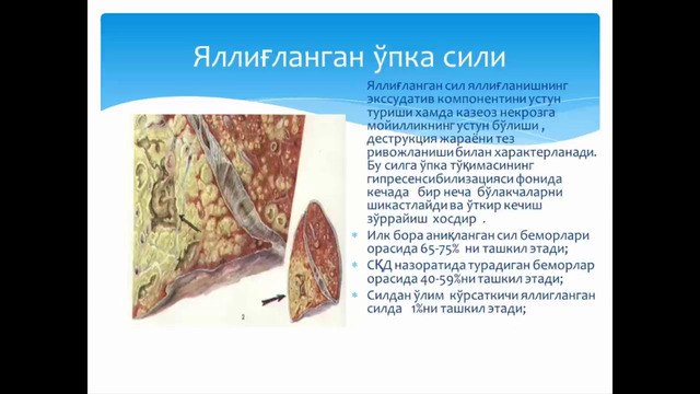 4 курс. Фтизиатрия. История учения о туберкулезе