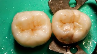 В. Щербаков: Реставрация жевательного зуба