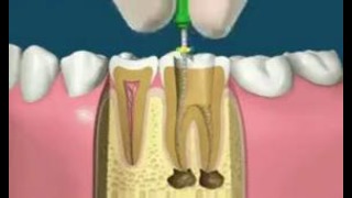 Процесс лечения зубов