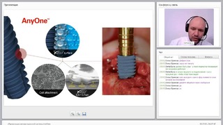 Вебинар: Презентация имплантационной системы AnyOne