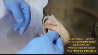 Стоматология DentalPremier – Виниры