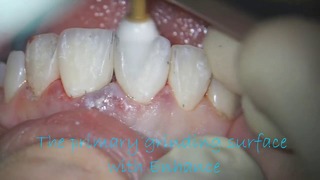 В. Щербаков: Реставрация фронтальных зубов