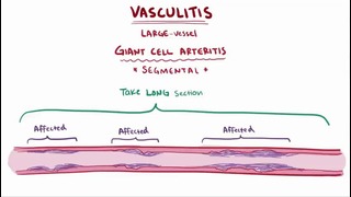 Vasculitis (Giant cell, Takayasu, Polyarteritis nodosa, Buerger, Granulomatosis)