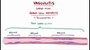 Vasculitis (Giant cell, Takayasu, Polyarteritis nodosa, Buerger, Granulomatosis)